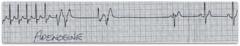 <p>Adenosine </p><p>-Chemical cardio converter </p><p>-Stops heart & resets the electrical impulses (will have long pauses before flips back) </p><p>-Educate pt that they will feel heart stop</p>