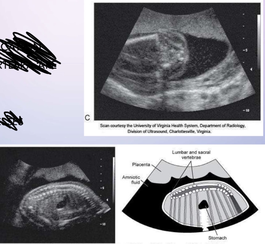 <p>3 primary ossification centers of each vertebra are sonographically distinguishable</p><ul><li><p>transverse processes</p></li><li><p>pedicles</p></li><li><p>laminae</p></li></ul><p></p>