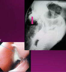 <p>You see a horse with unilateral nasal discharge. Endoscopy shows pus at the *nasomaxillary opening*, and radiographs show a fluid line. Thoughts?</p>