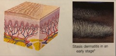 <p>rough, thickened epidermis secondary to persistent rubbing, itching, or skin irritation; often involves flexor surface or extremity</p>