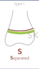 <p>epiphysis separated from metaphysis</p>