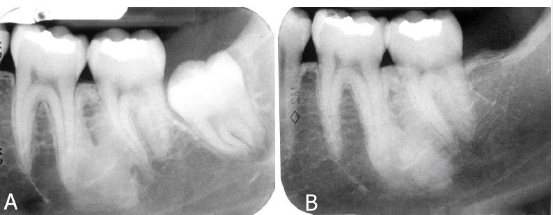 <p>idiopathic osteosclerosis</p>
