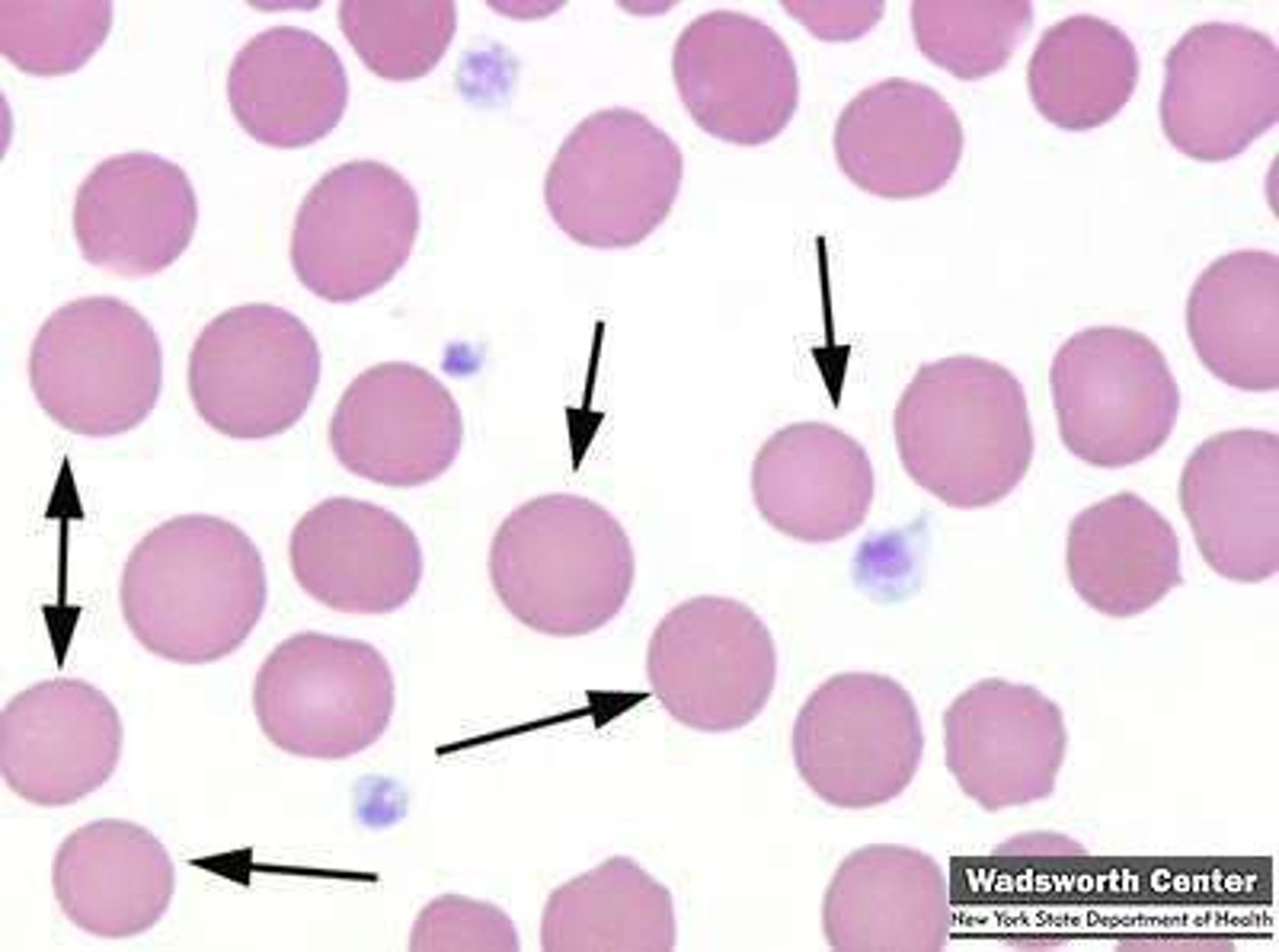 <p>RBC membrane defect in tethering proteins: spectrin/band 3.1/ankyrin,</p><p>Hemolytic anemia, jauncide, and splenomegaly often after URIs</p>