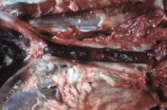 <p>Which type of thrombus is</p><p>represented in this image?</p><p>What would be the likely</p><p>outcome of this thrombus?</p>