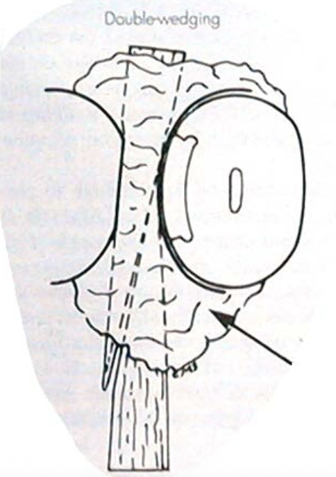 <ul><li><p>used for wide proximal boxes (B/L) </p></li><li><p>wedges are side by side, not stacked</p></li></ul><p></p>