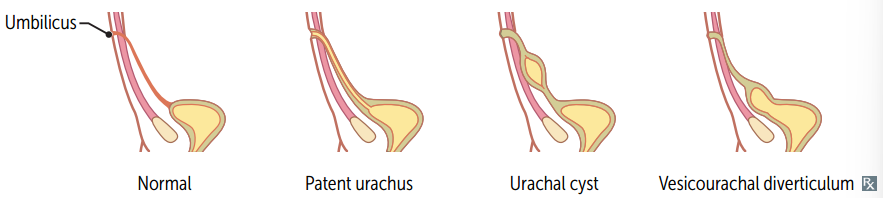 It may become infected → painful midline mass below the umbilicus
