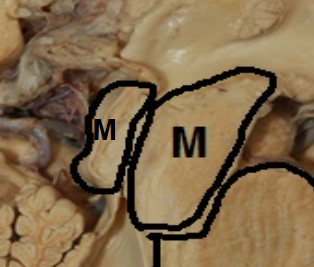 <p>What splits the midbrain down its centre?</p>