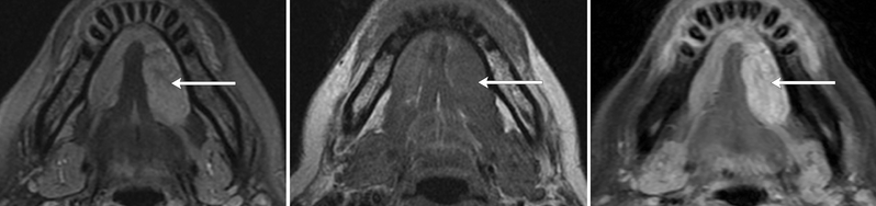 <p><span style="line-height: inherit; font-size: inherit;">A <strong>submandibular salivary gland abscess</strong> is a mucus-filled retention cyst derived from obstructed or traumatized salivary ducts. </span></p><p><strong>Appearance on MRI:</strong></p><ul><li><p><span style="font-family: inherit; line-height: inherit; font-size: inherit;">•</span></p><p>Hypointense on<strong> T1-weighted images</strong></p></li><li><p><span style="font-family: inherit; line-height: inherit; font-size: inherit;">•</span></p><p>Hyperintense on <strong>T2-weighted images</strong></p></li><li><p><span style="font-family: inherit; line-height: inherit; font-size: inherit;">•</span></p><p>Post-Contrast<strong> T1 Enhancement</strong></p></li></ul><p></p>