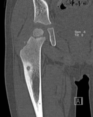 <p>What is this?</p><p>- 10-25 yo, male</p><p>- Pain (Relieved by aspirin)</p><p>- Cortical - Femur, Tibia, Neural arch</p>