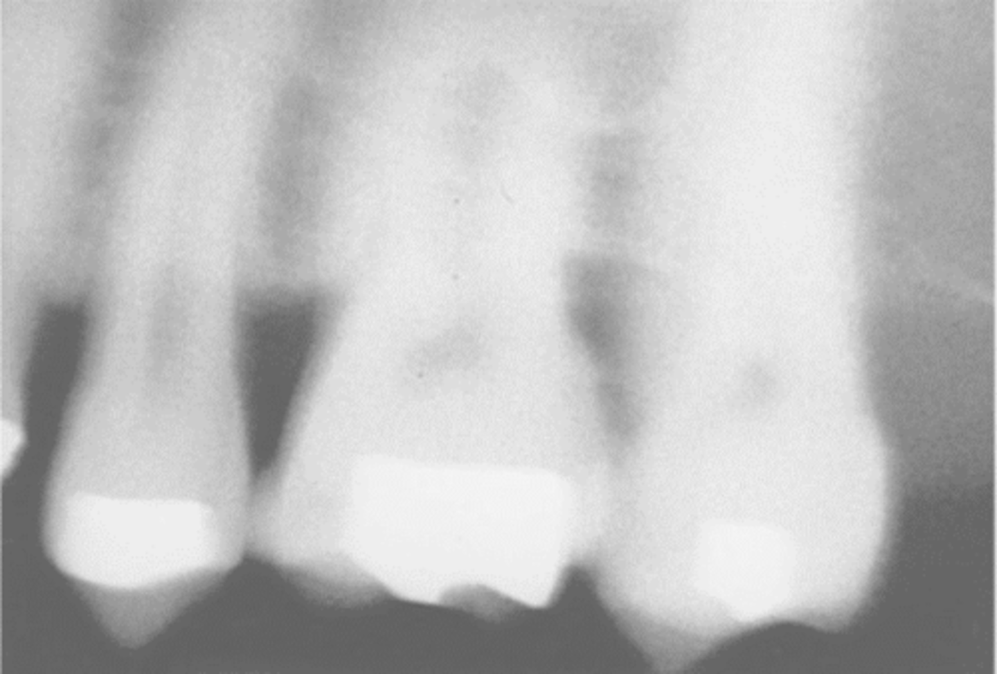 <p>What causes a blurred radiographic image?</p>