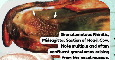 <p>multiple and often confluent granulomas</p>