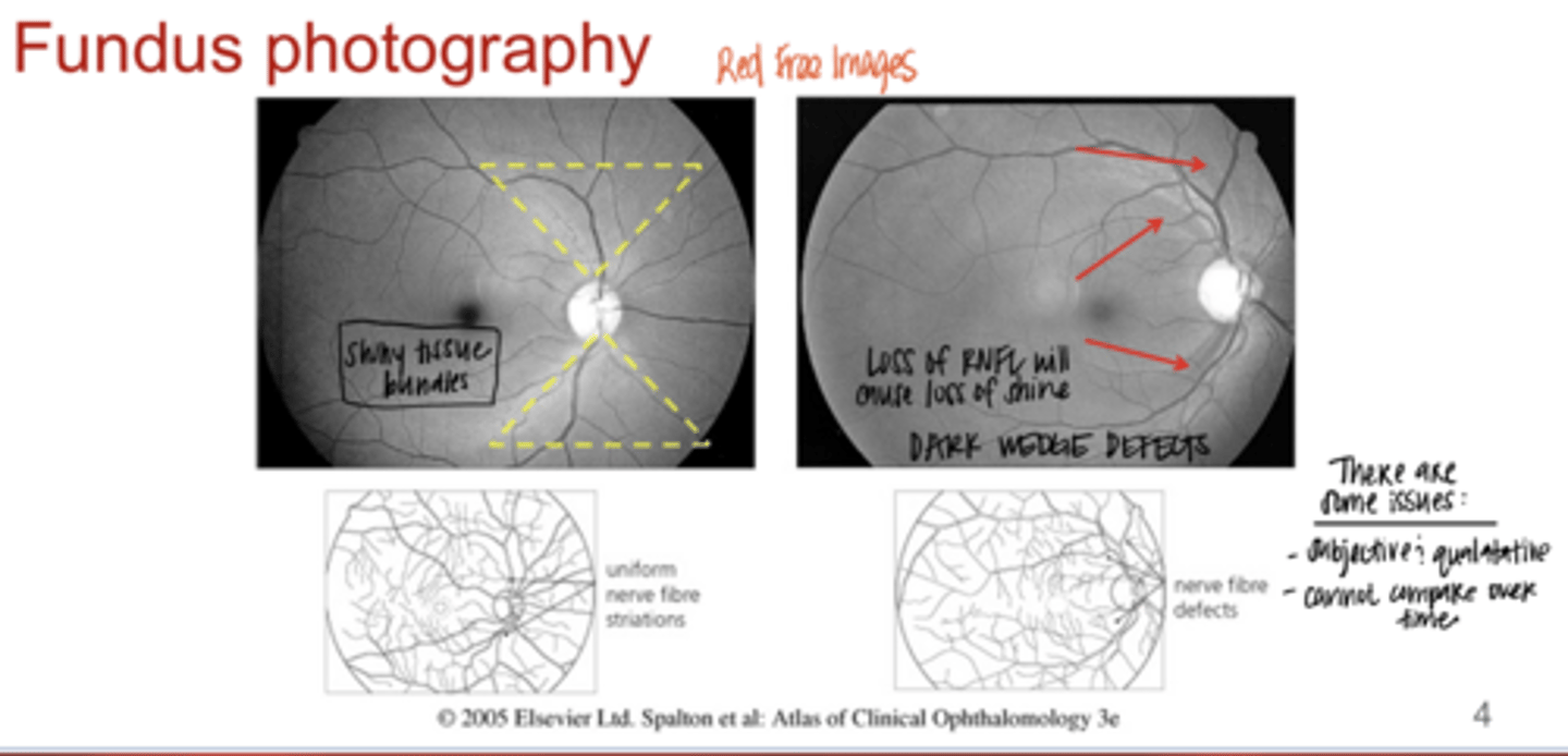 <p>What are the issues with Fundus Photography when managing glaucoma?</p>