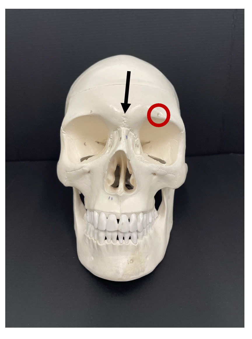 <p>What is the name of the bony landmark of the frontal bone that the arrow is pointing to?</p>