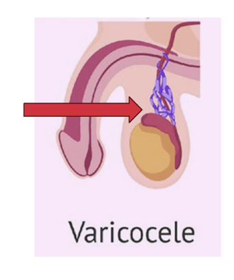 <p>abnormal <strong>dilation</strong> of the <strong>veins</strong> within the <strong>spermatic</strong> <strong>cord</strong> caused by <strong>incompetent</strong> <strong>venous</strong> <strong>valves (venous insufficiency)</strong>.</p><ul><li><p>like varicose veins, but in the scrotum area</p></li></ul><p></p>