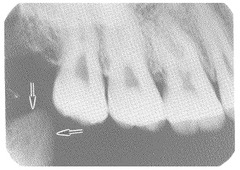 <p>coronoid process</p>