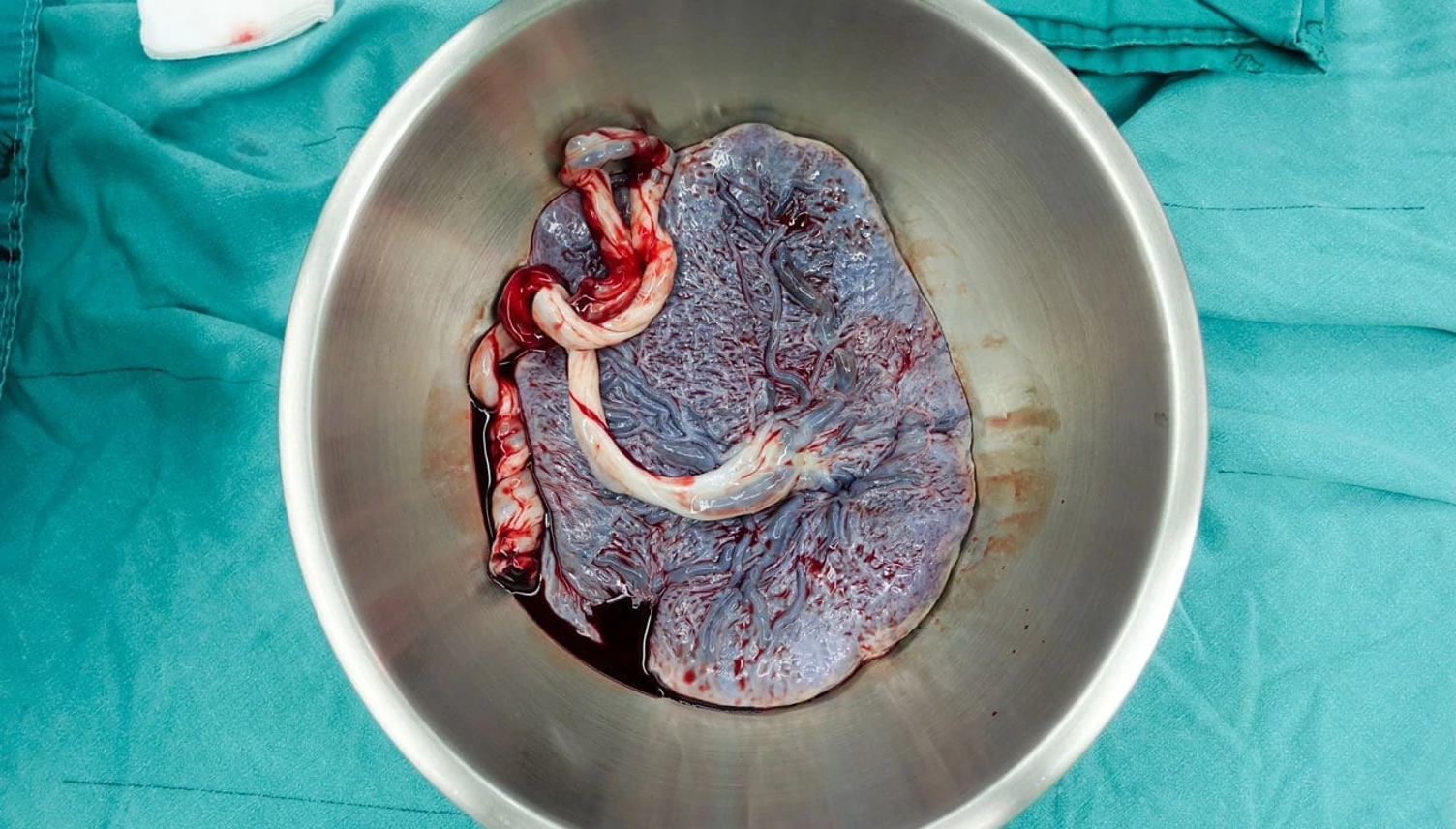 <ul><li><p><span><span>Gentle and controlled cord traction</span></span></p></li><li><p><span><span>Uterine massage</span></span></p></li><li><p><span><span>Oxytocin started (especially if boggy uterus)</span></span></p></li></ul><p></p><p></p>