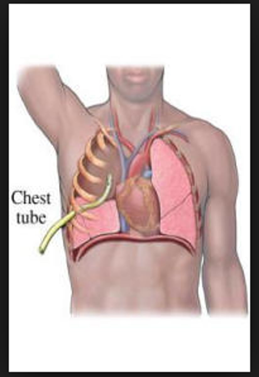 <p>large-bore tube inserted into chest cavity to drain excess fluid or maintain pulmonary inflation</p>