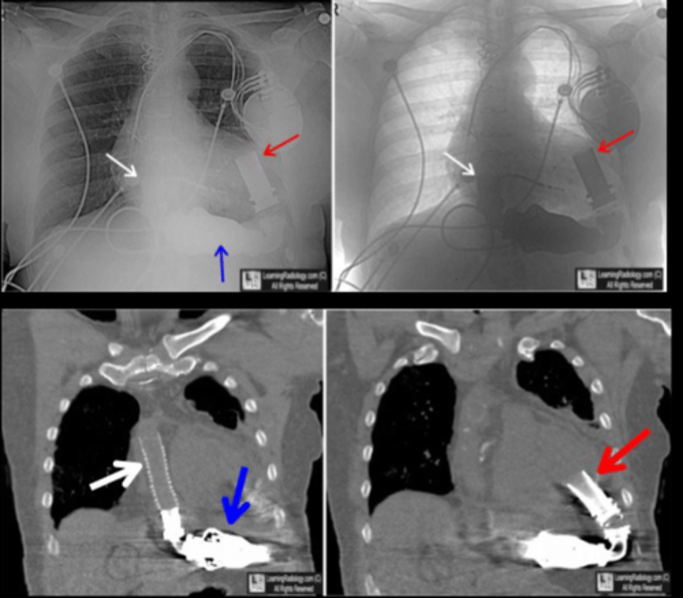 <p>Cannula for ascending aorta (white arrows); pump (blue arrows); LV cannula (red arrows)</p>