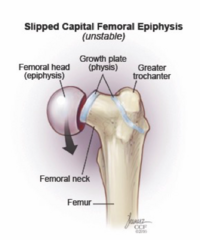 <p>Common condition of the proximal femoral physis (growth plate)</p><p>Slippage of the metaphysis relative to the epiphysis, main cause of premature OA in young adults</p><p>During periods of rapid growth (10-16 yrs old)</p>