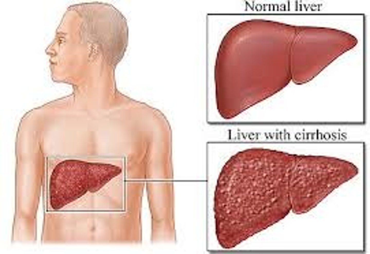 <p>cirrhosis</p>