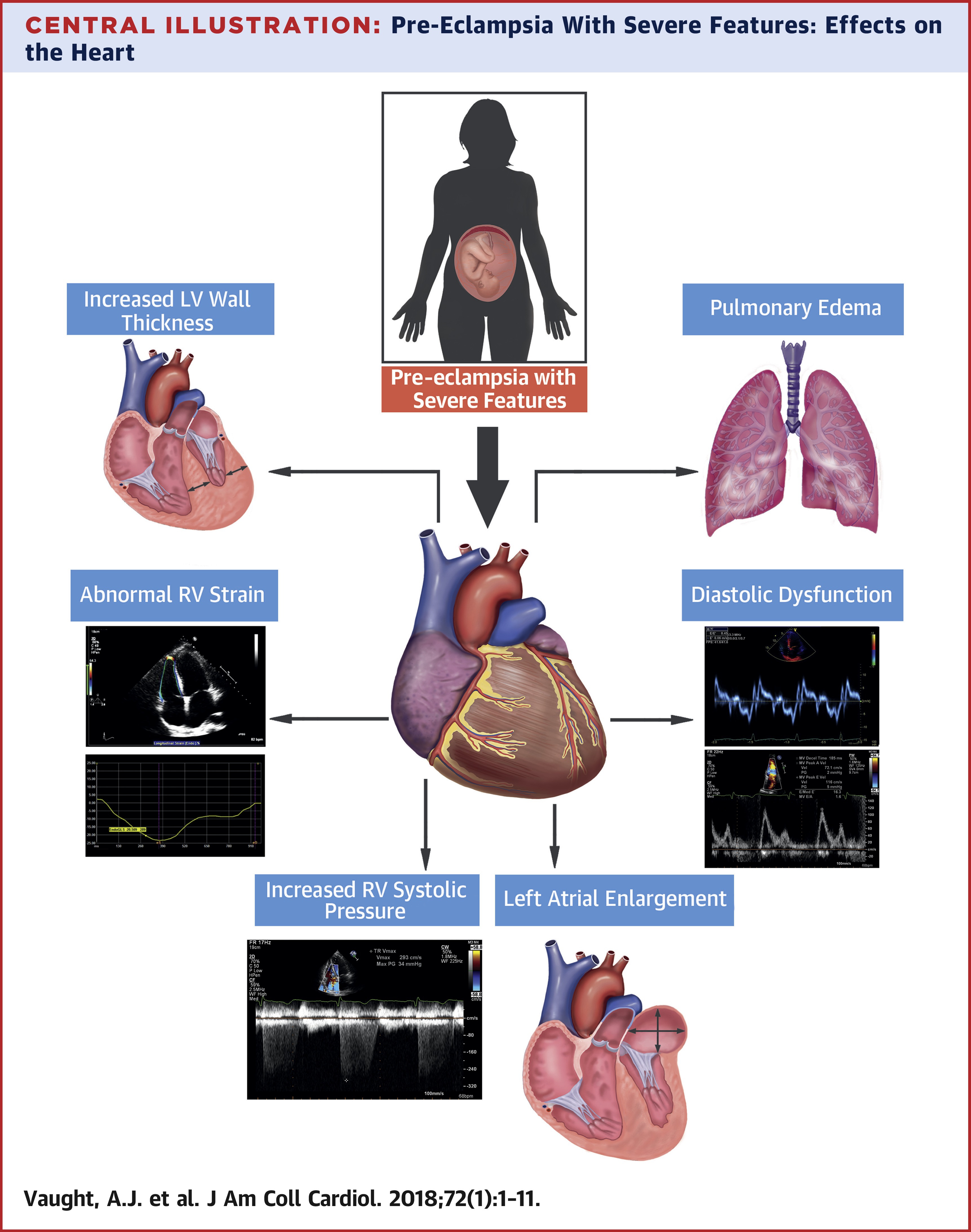 <p>preeclampsia</p>
