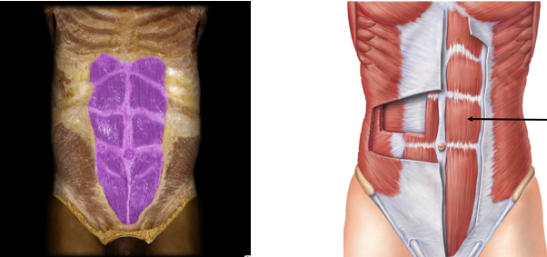 <p>trunk flexion</p>