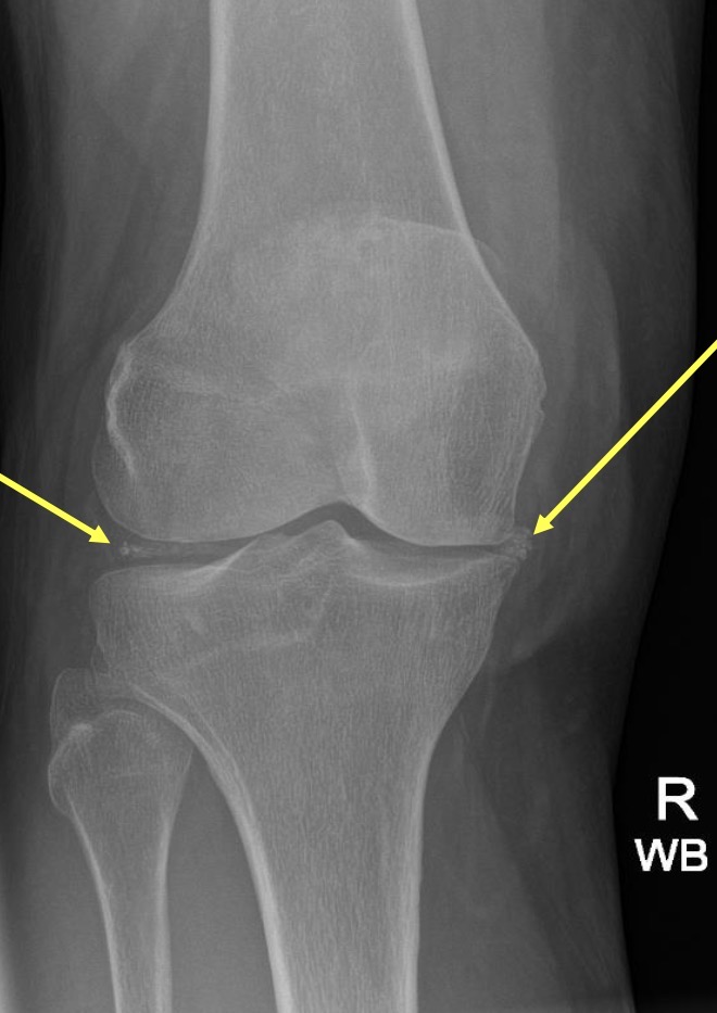 <ul><li><p>Also known as pseudogout</p></li><li><p>Calcium deposit within the joint</p></li></ul><p>State it as ‘Calcium deposition within the joint space consistent with CPPD or pseudogout’</p><p></p>