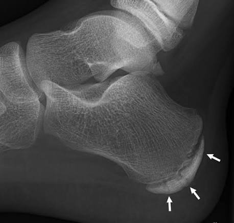 <p>Sever’s apophysitis</p>