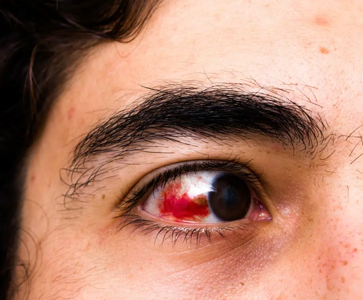 <p>What bandaging technique should be used for this injury?</p>