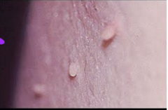 <p>AKA skin tag, no clinical importance</p>