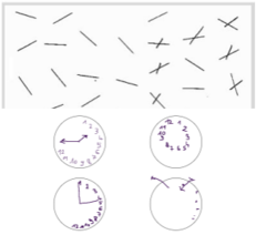 <p>condition where the region of space contralateral to the brain lesion is perceived as not existing (I.e. denying of the existence of contralateral limb)</p>