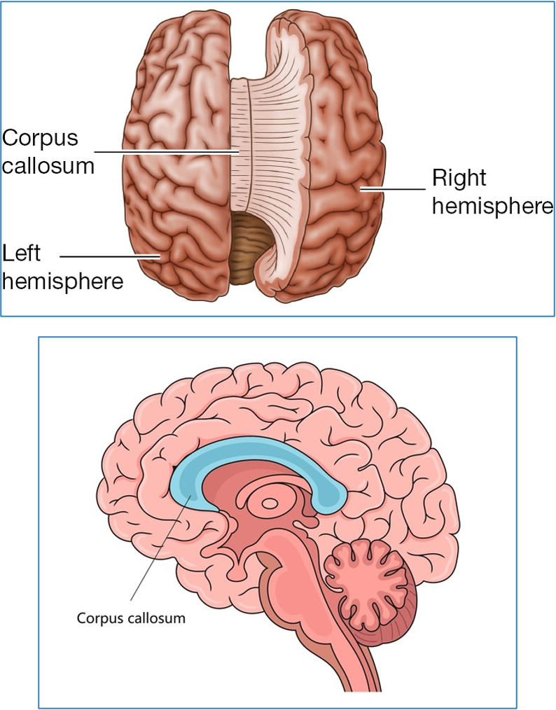 <ul><li><p>thick bundle of fibres that connects the rt. and lt. hemispheres of brain</p></li><li><p>enables communication b/w both hemispheres</p></li><li><p>midline, superior to thalamus</p></li><li><p>not routinely assessed w/ u/s</p></li></ul><p><strong>sono app:</strong></p><ul><li><p>hypo, curved structure midline brain</p></li><li><p>best seen SAG view</p></li><li><p>CSP inferior/posterior to CC</p></li></ul><p></p>