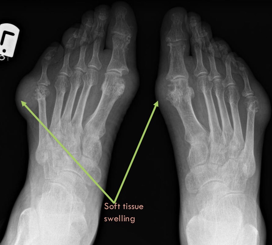 <p>Gout <span data-name="star" data-type="emoji">⭐</span></p>