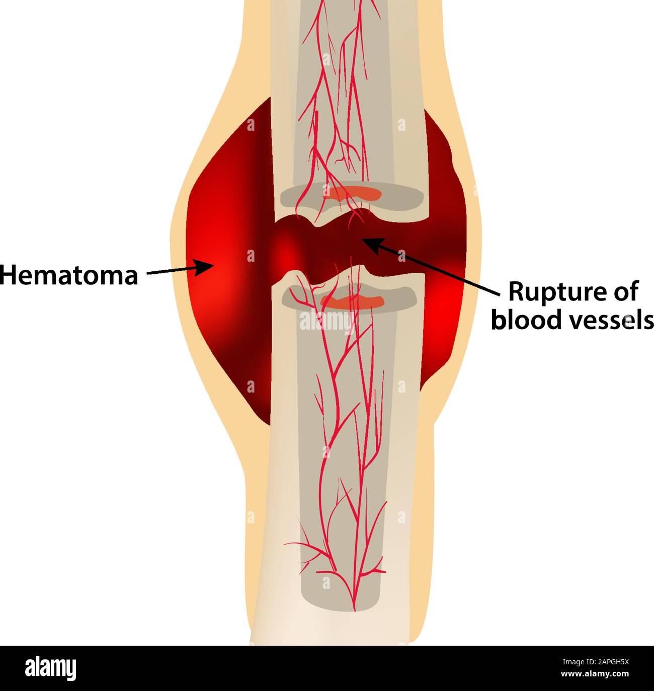 <p>First stage of bone fracture repair where torn blood vessels bleed and form a mass of clotted blood at the fracture site </p>