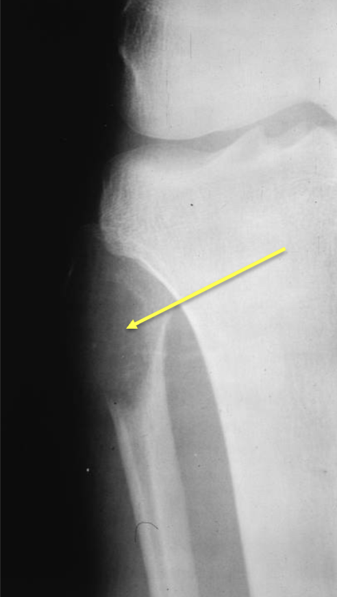 <p>What benign bone tumour is this, where is it, and what features can be seen?</p>