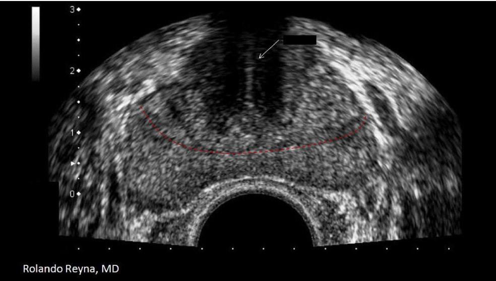 <p>The red dotted line separates what two zones of the prostate?</p><p>A. peripheral and anterior fibromuscular</p><p class="p1">B. transitional and peripheral</p><p class="p1">C. verumontanum and central</p><p class="p1">D. central and transitional</p>