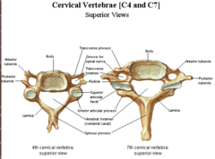 <p>*transverse foramen* </p><p>-is found in the transverse process of all cervical vertebrae. </p><p>-The *vertebral artery* ascends through this foramen from *CV6-CV1*</p><p>*bifid spinous process*</p><p>- divides into two smaller projections. </p><p>-found on cervical vertebrae *CV2-CV6*</p><p>*bifid transverse processes* </p><p>-divided into two projections</p><p>1. anterior </p><p>2. posterior tubercles</p><p>-found on cervical vertebrae *CV3-CV6*</p>