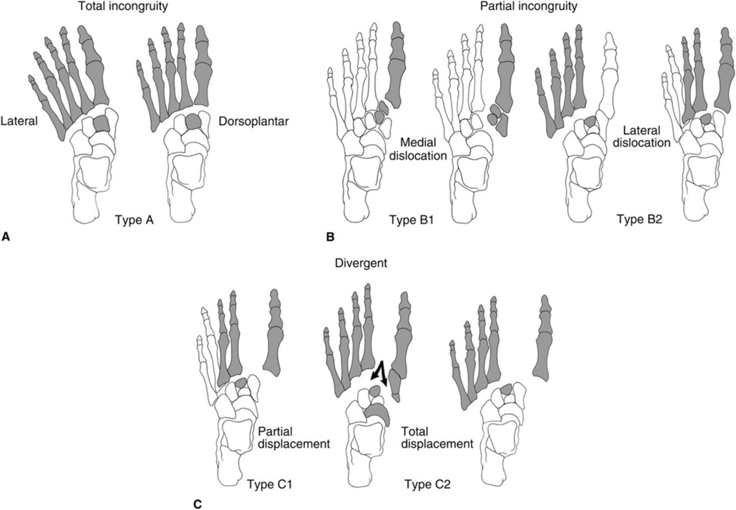 <p>Lisfranc Dislocation</p><p>A1 - homolateral</p><p>A2 - homomedial Type B - partial incongruity</p><p>Bl - partial medial displacement</p><p>1st metatarsal displaced medially and/or in combination with metatarsals 2-4</p><p>B2 - partial lateral displacement</p><p>Lateral displacement of one or more lesser metatarsals</p><p>Type C - divergent</p><p>Cl - partial displacement</p><p>1st metatarsal displaced medially with any combination of metatarsals 2-4 displaced laterally</p><p>C2 - total displacement</p><p>1st metatarsal displaced medially with metatarsals 2-5 displaced laterally</p>
