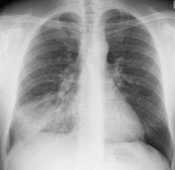 <p>is the attached image an example of effusion or infiltrate?</p>