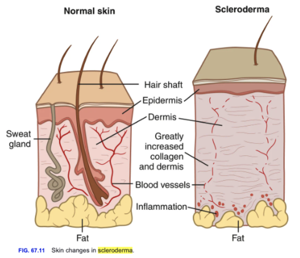 <p>An autoimmune connective tissue disease characterized by fibrosis and vascular abnormalities.</p><ul><li><p>overproduction of collagen = stiffness + occlusion of blood vessels </p></li></ul><p></p>