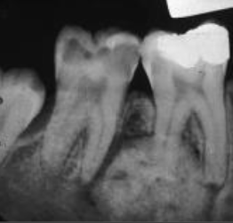 <p>young, 2/3 pain, 1st or 2nd molar, halo rim </p>