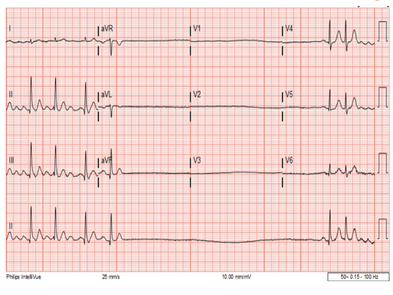 <p>korte pauze tussen het stoppen van een hartritmestroonis en het moment waarop de sinusknoopt weer een normale hartslag produceert</p><ul><li><p>bv bij aanval van: atriumfibrilleren, atirumflutter of supraventriculaire tachycardie (SVT)</p></li></ul><p></p>