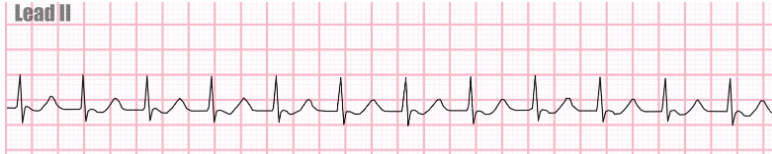<p>Identify the arrhythmia shown on the EKG strip</p>