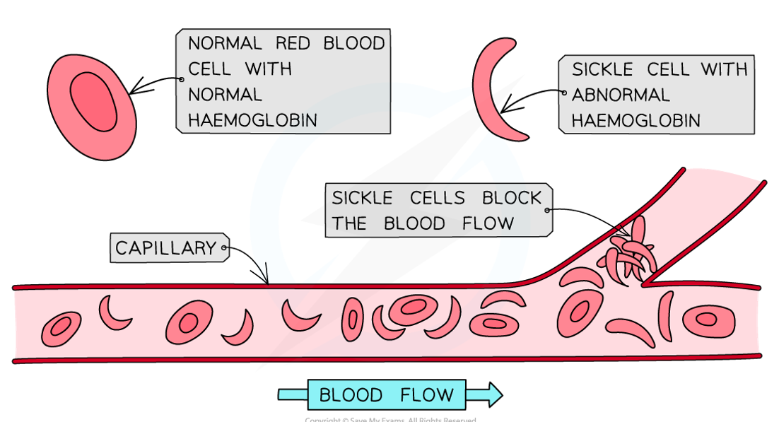 <ul><li><p>Genetic condition that is common among people originating from malaria-stricken areas that results in abnormal haemoglobin</p></li><li><p>Impaired ability to transport oxygen (blocks small capillaries) causing rapid heart rate, fatigue &amp; dizziness</p></li></ul><p></p>