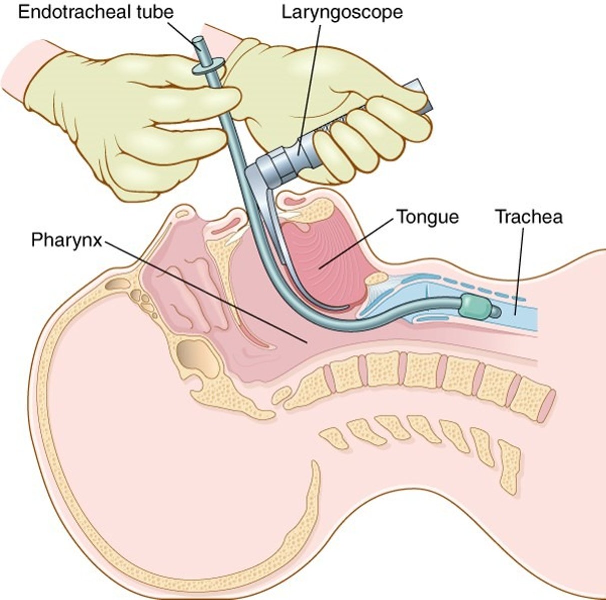 <p>breathing tube inserted through mouth into trachea</p>