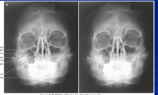 <p>MOD WATERS FACIAL BONES</p>