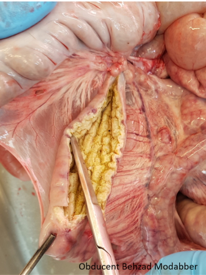 <p><strong>Du obducerar en 10 veckor gammal gris och ser en förändrad och kraftigt förtjockad</strong></p><p class="p1"><strong>slemhinna i ileum (se bild) och till mindre del colon. Vilket agens misstänker du i första</strong></p><p class="p1"><strong>hand? (1p)</strong></p>