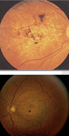 <ul><li><p>Onset in the 1st or 2nd decade</p></li><li><p>Progressive central vision loss</p></li><li><p>Vision may decline to ~20/200</p></li></ul><p></p>