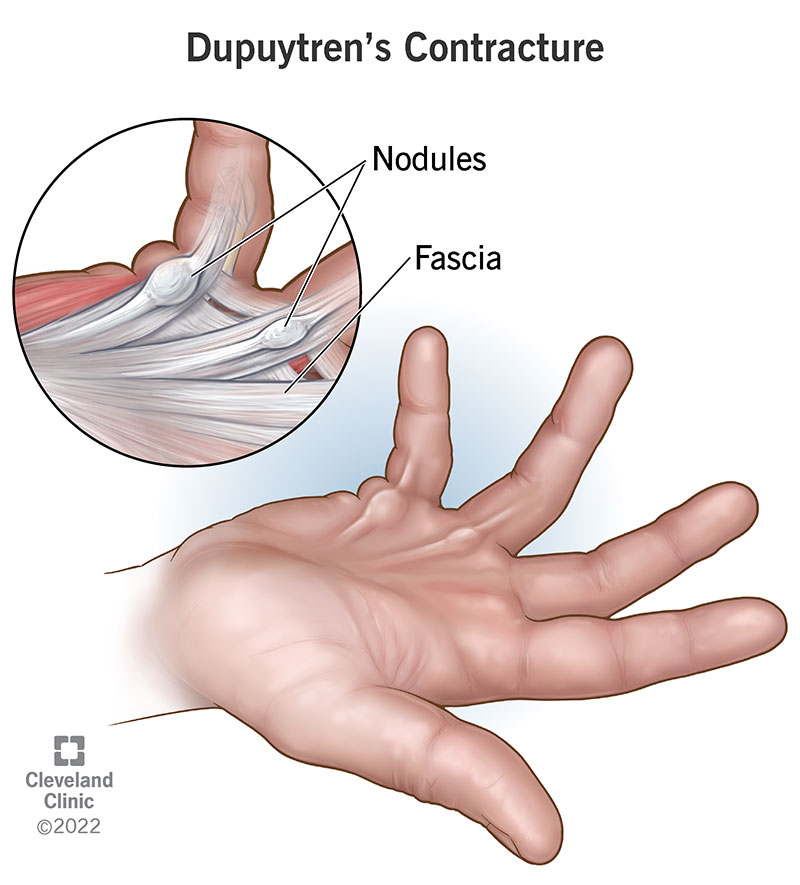 <p>Dupuytrens Contracture</p>