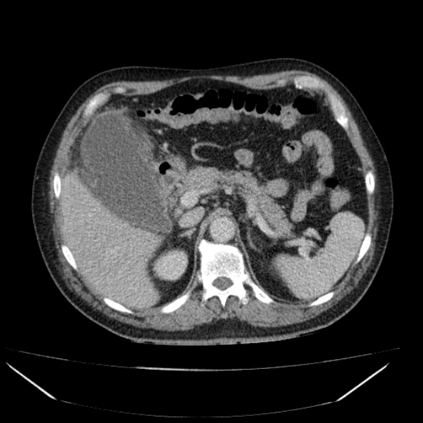 <p>What are imaging findings and what do you suspect</p>